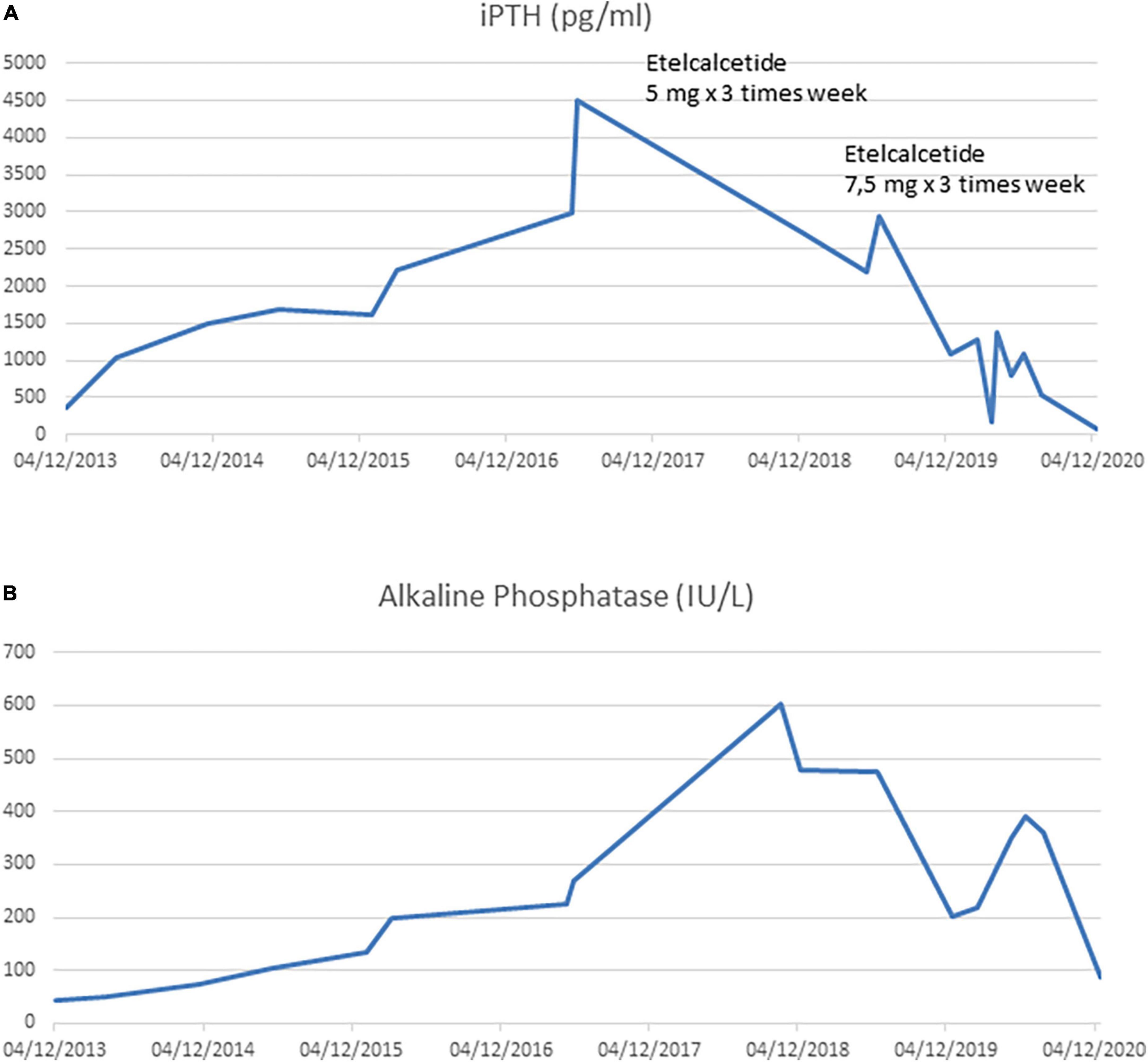 Does Etelcalcetide reverse myelofibrotic bone changes due to hyperparathyroidism? A case report